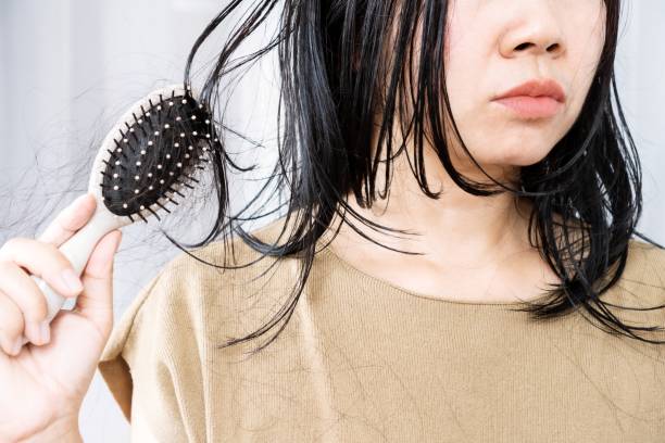 Hair Loss in Women with PCOS: